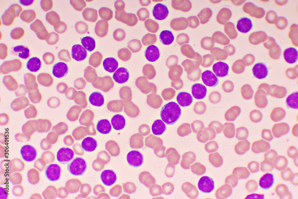 Blood picture of chronic lymphocytic leukemia or CLL, analyze by microscope, original magnification 1000x Blood picture of chronic lymphocytic leukemia or CLL, analyze by microscope, original magnification 1000x