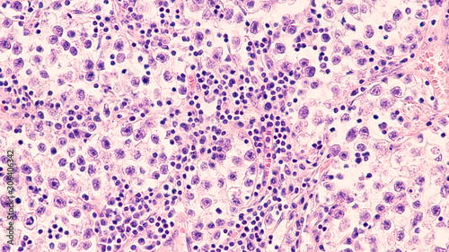 Testicular Cancer: Photomicrograph of seminoma, a malignant germ cell tumor of the testis (testicle). It has a survival rate of 95%