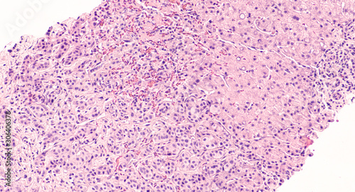 Photomicrograph of core biopsy of liver showing metastatic breast cancer (invasive ductal carcinoma).  Tumor cells seen lower left, liver tissue upper right.   photo