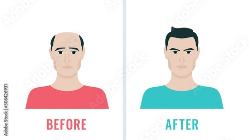 Before and after hair transplantation treatment cartoon animation. Unhappy man with alopecia becomes happy after hair regeneration. Motion graphic for hair clinics and diagnostic centres