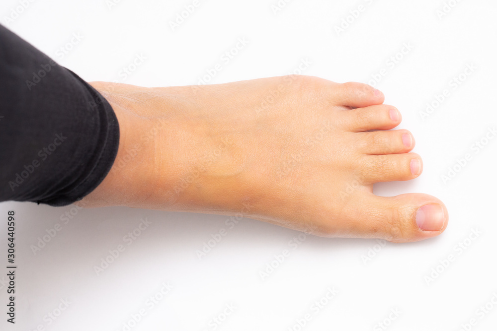 Girl's foot isolated on white background which recalls the concept of hyperhidrosis on feet