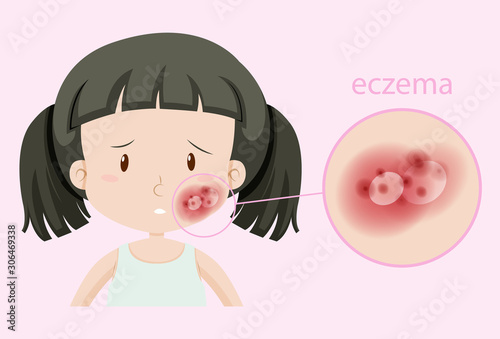Girl with eczema on face