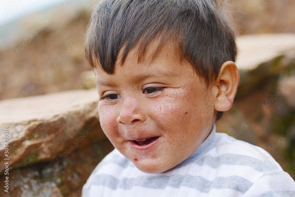 Happy little latin boy with damaged face skin. Happy little latin boy with damaged face skin.