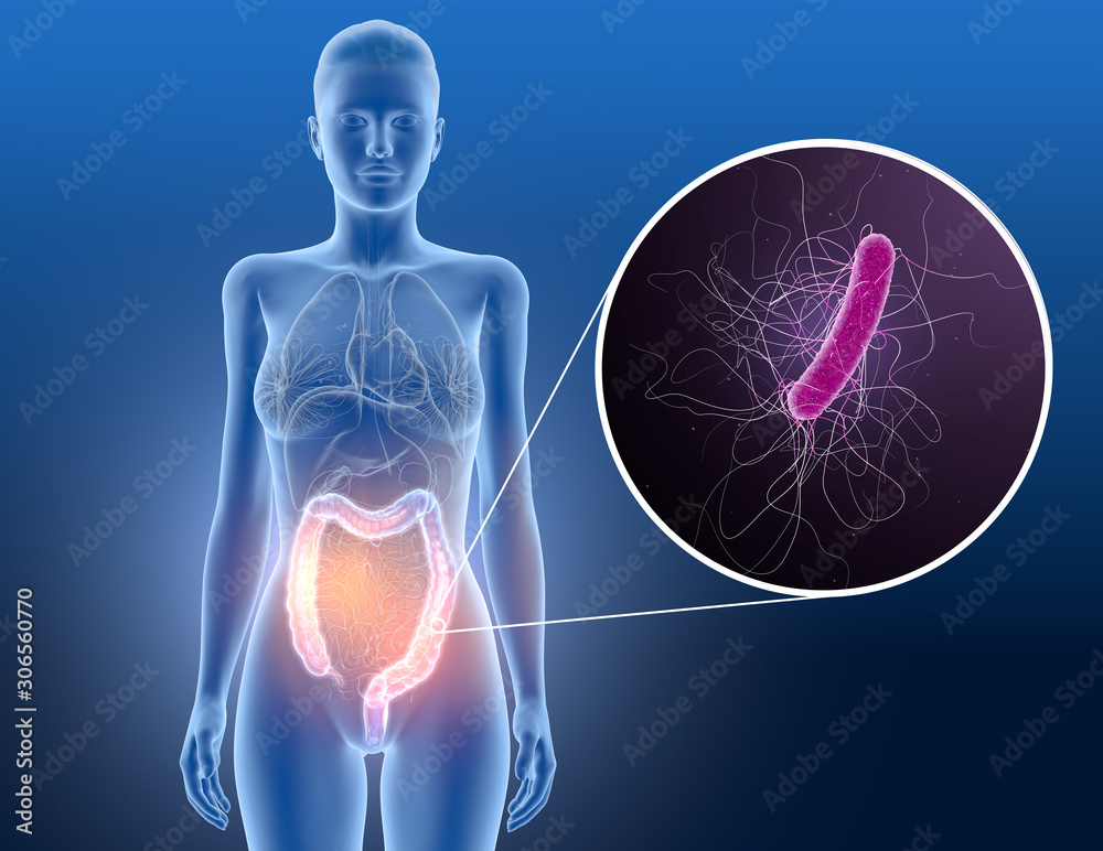 Colitis, bacterium clostridium difficile in large intestine, scientific 3D illustration