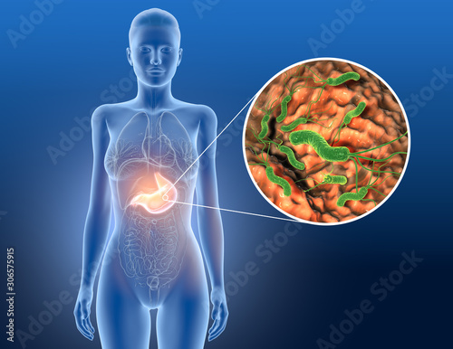 Foto Gastritis, helicobacter pylori bacteria in stomach, medically accurate 3D illustration