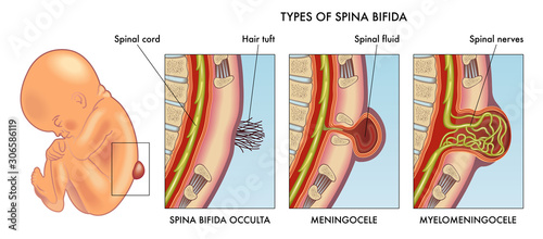 Medical illustration of infant spina bifida with annotation.