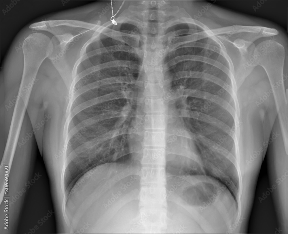normal radiography of the child's chest in direct projection, medical diagnosis normal radiography of the child's chest in direct projection, medical diagnosis