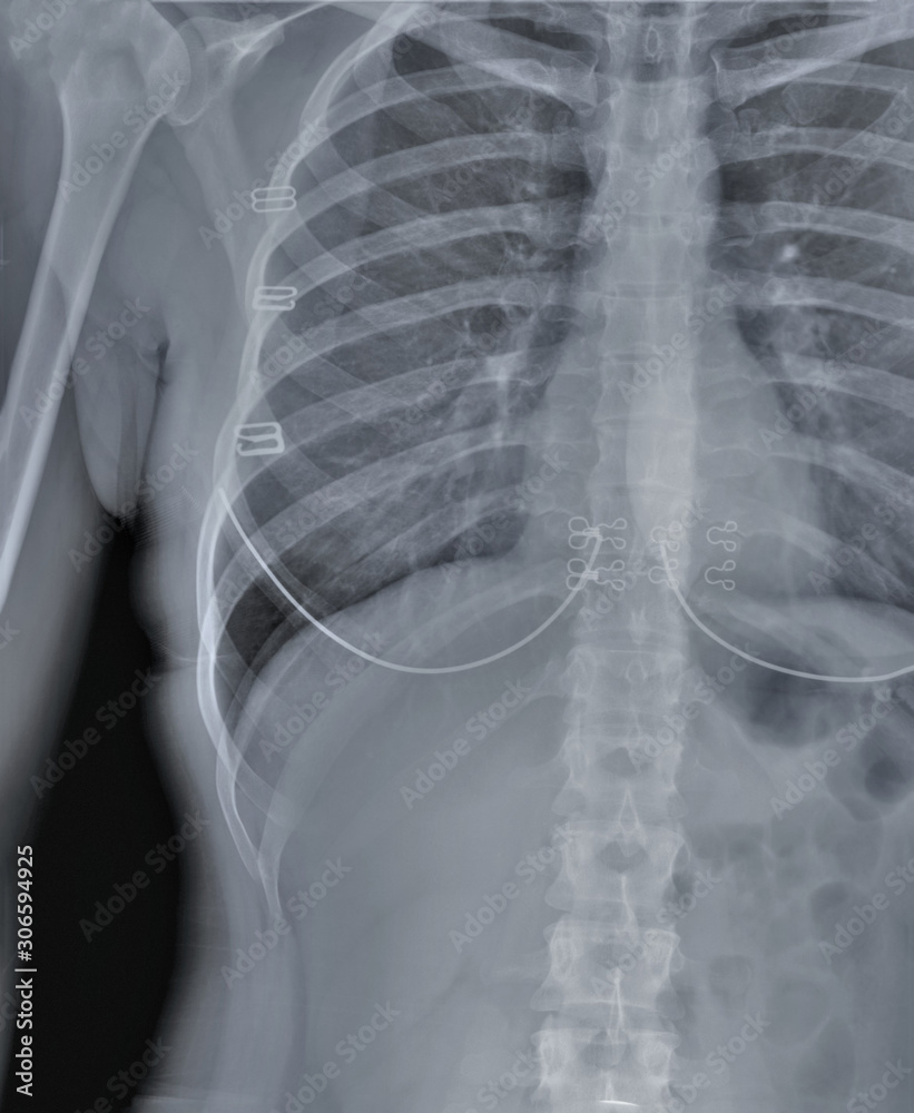 normal radiography of chest organs in direct projection, Traumatology and orthopedics, pulmonology
