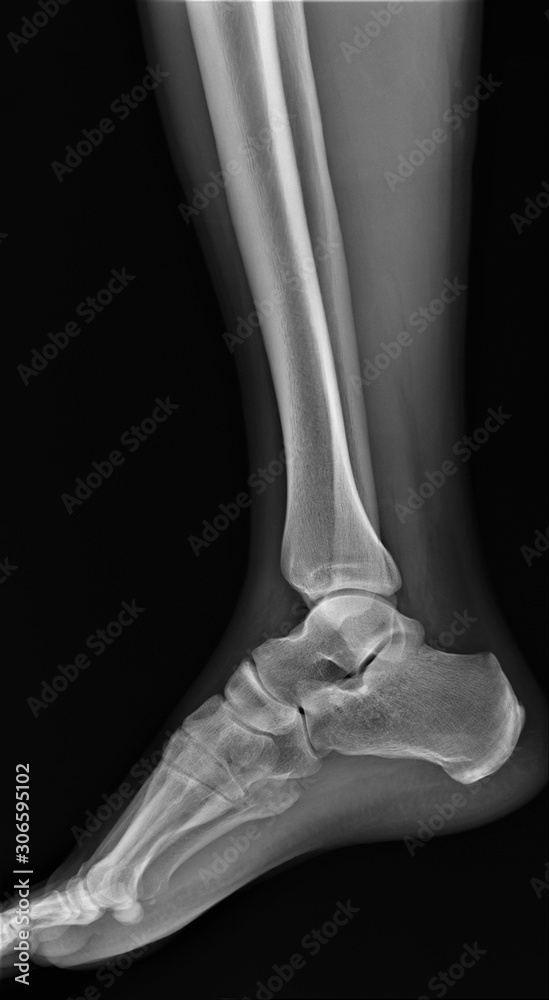 normal radiograph of the ankle joint normal radiograph of the ankle joint