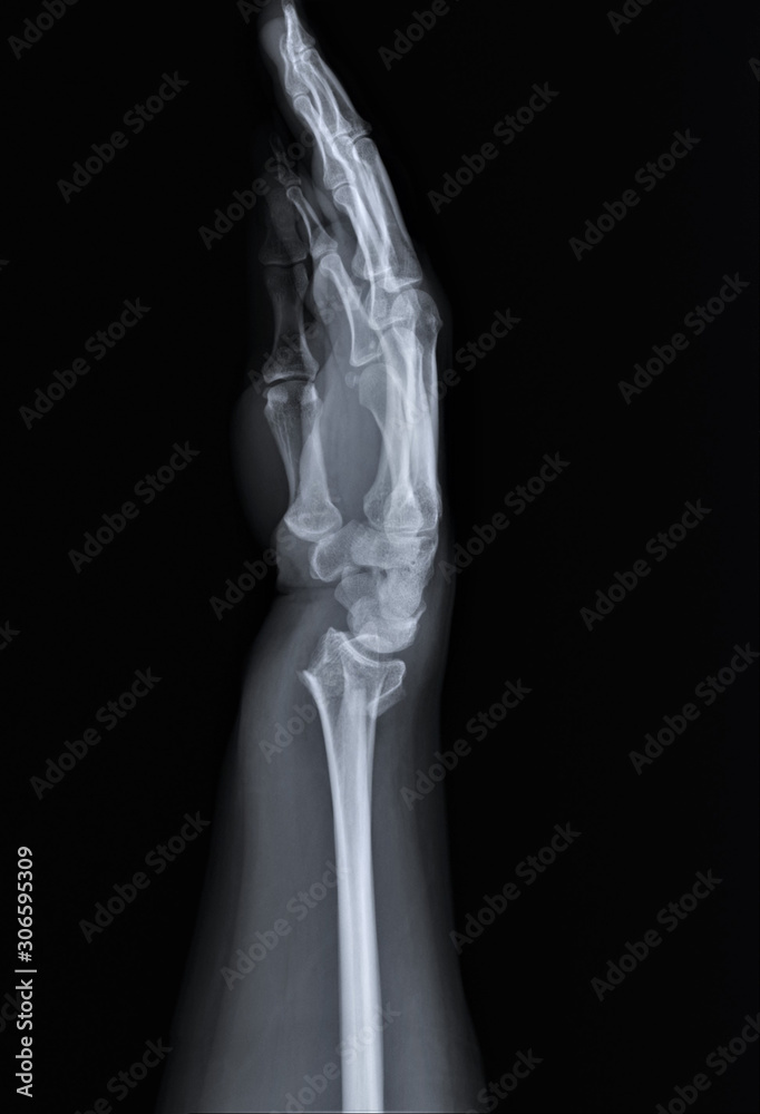 radiography of forearm and wrist bones with a fracture of the distal radius, Traumatology and orthopedics radiography of forearm and wrist bones with a fracture of the distal radius, Traumatology and orthopedics
