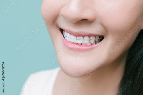 Asian woman wareing orthodontic retainers.Teeth retaining tools after braces .