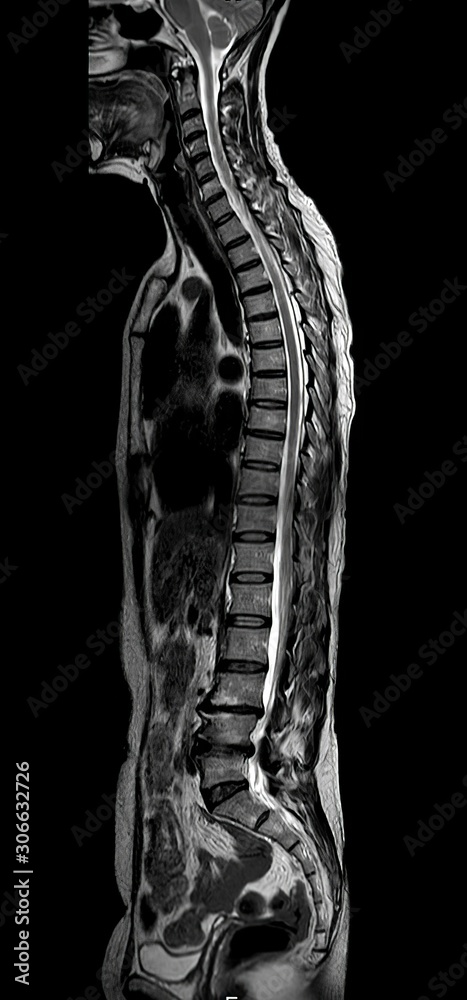 MRI of whole spine sagittal plane Stock Illustration | Adobe Stock