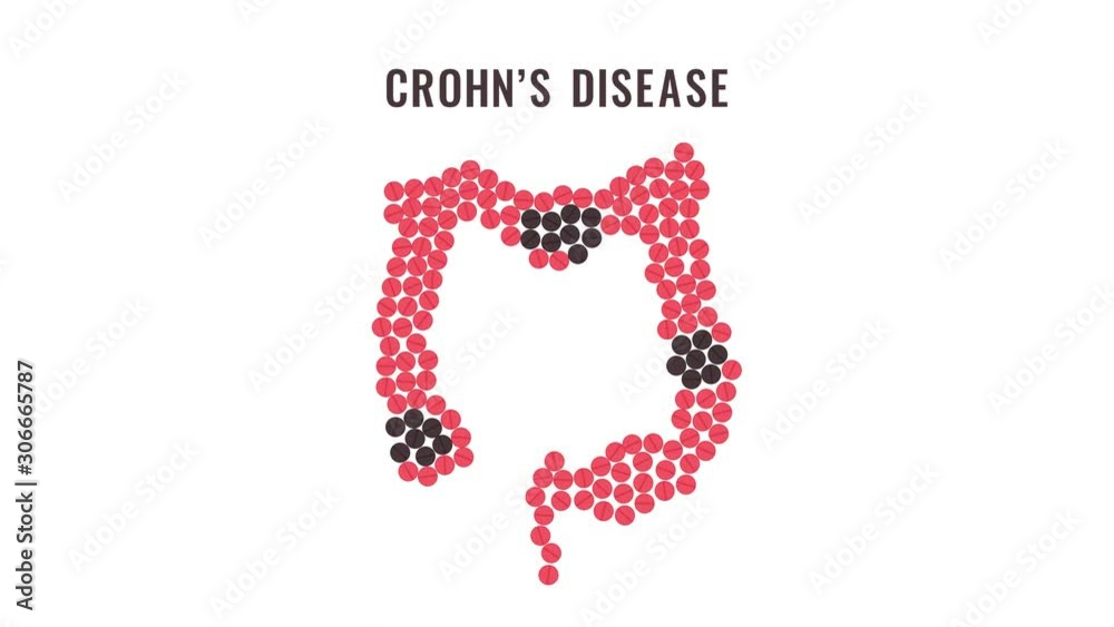 Crohn's disease awareness animation of red and black pills forming intestine. Inflammatory bowel disorder motion graphics. Medical solidarity concept. Human body organ treatment. Crohn's disease awareness animation of red and black pills forming intestine. Inflammatory bowel disorder motion graphics. Medical solidarity concept. Human body organ treatment.