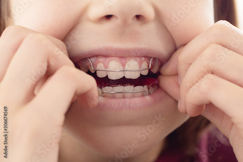 Child with removable orthodontic appliance in mouth. Concept of healthy teeth and a beautiful smile. 