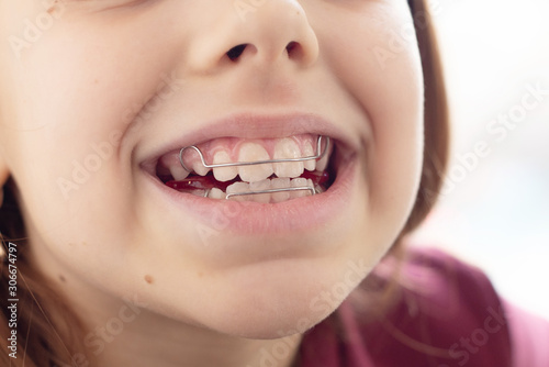 Child with removable orthodontic appliance in mouth. Concept of healthy teeth and a beautiful smile. 