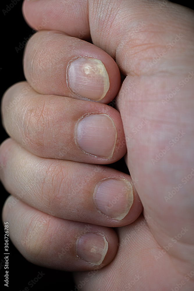 AAD tips to Improve Nail Psoriasis at Home