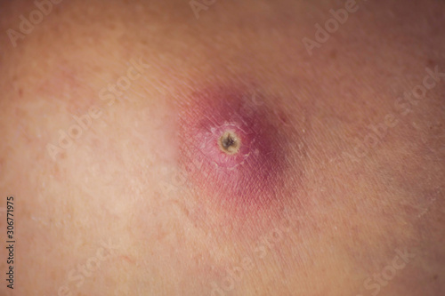 Skin of woman with big and painfull furuncle. Medicine and skincare concept