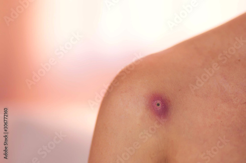 Skin of woman with big and painfull furuncle. Medicine and skincare concept