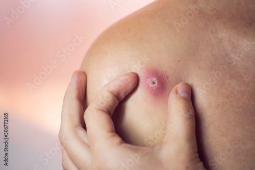 Woman tries to crush boil on her shoulder. Medicine and skin care concept photo