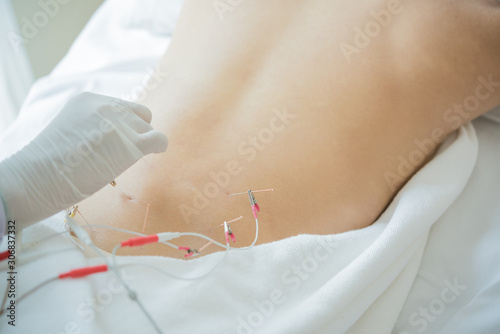 Young woman undergoing acupuncture treatment