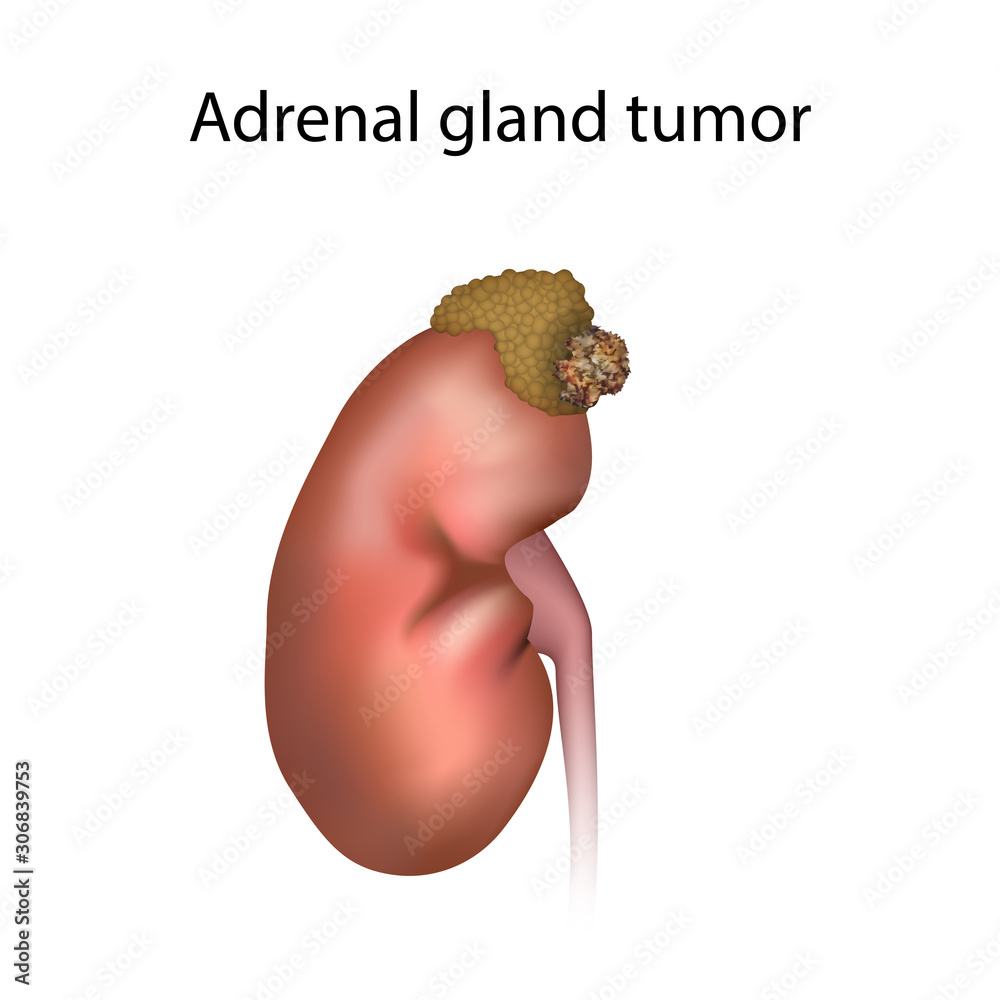 Adrenal gland tumor. Disease. Medical anatomy illustration. Stock