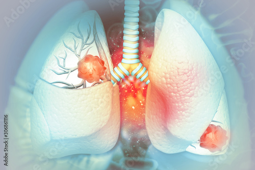 Tableau sur toile Lung cancer. lung disease. 3d illustration