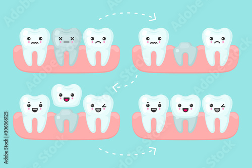 Fototapeta Naklejka Na Ścianę i Meble -  Dental crown setting, stomatology vector concept illustration. Procedure of implant veneer with one artificial tooth