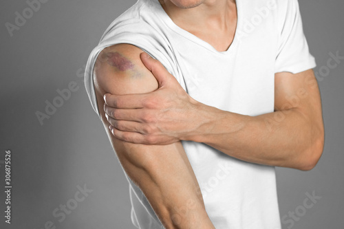 The bruise on the shoulder. Shoulder pain. The man holds his hand. Close up photo