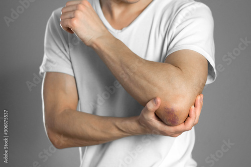 The bruise on the elbow. Pain in the elbow. The man holds his hand. Close up