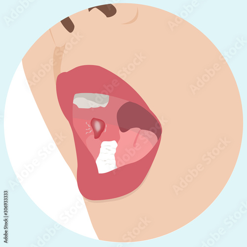 A mouth ulcer  vector illustration 