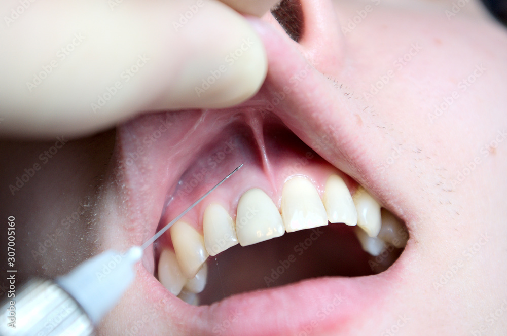 dental anesthesia in the dentist's chair, needle of dental syringe, infiltration anesthesia