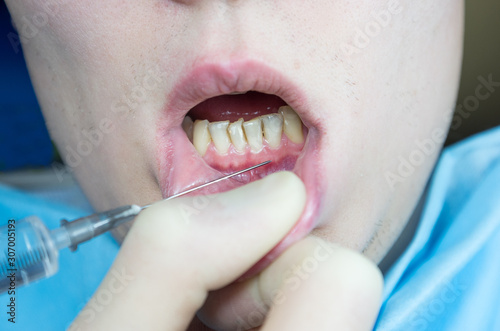 Obraz na plátně dental anesthesia in the dentist's chair, needle of dental syringe, infiltration