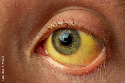 yellow staining of the sclera of the eye in diseases of the liver, cirrhosis, hepatitis, bilirubin photo