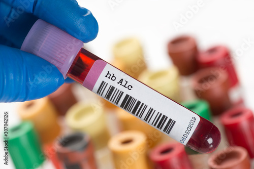 Hemoglobin A1c blood test tube photo