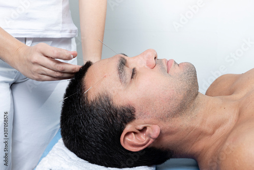 Therapist adjusting acupuncture needles on man head in aculpulture treatment.