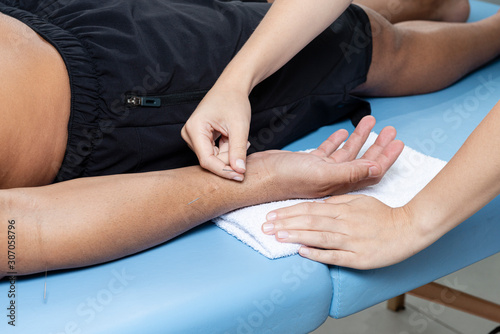 Detail of therapist adjusting acupuncture needles on man hand in aculpulture treatment.
