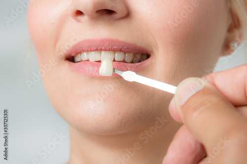 Close up of dentist using shade guide at woman's mouth to check veneer of teeth for bleaching