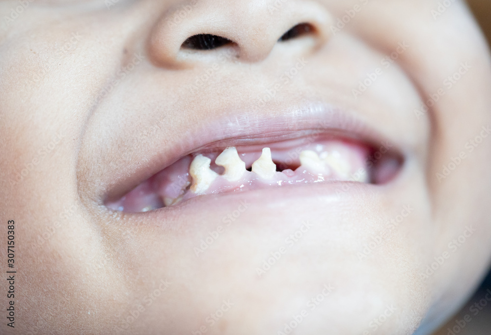 Fototapeta premium Close up image of toddler teeth with caries.Kid boy patient open mouth showing caries teeth decay for Dentist in Dental clinic.