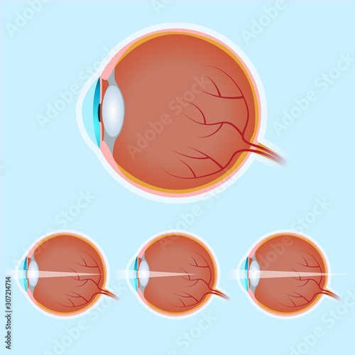 Human Eye Anatomy, Normal Eye, Myopia and Hyperopia, Visual Impairment