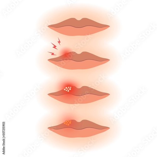 Human lips with herpes stages, treatment of viral infection