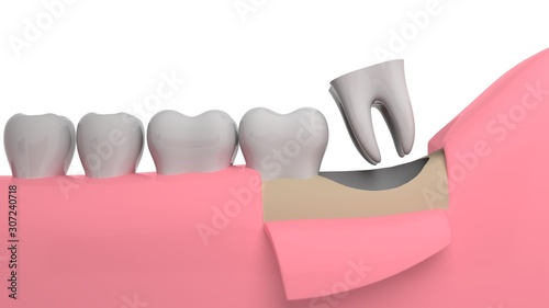 Wisdom tooth removing, 3D-rendering, white background