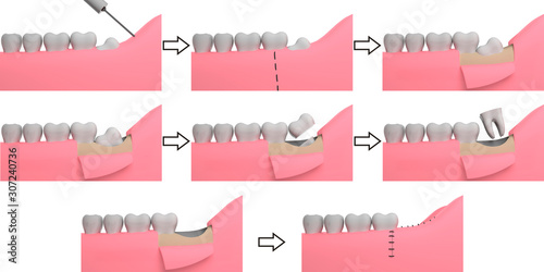 Wisdom tooth removing, collage, 3D-rendering, white background photo