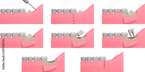 Wisdom tooth removing, collage, 3D-rendering, white background