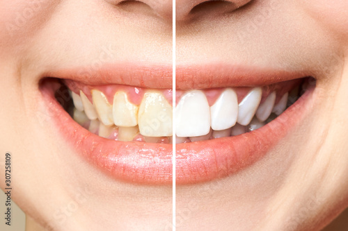 Photo woman teeth before and after whitening