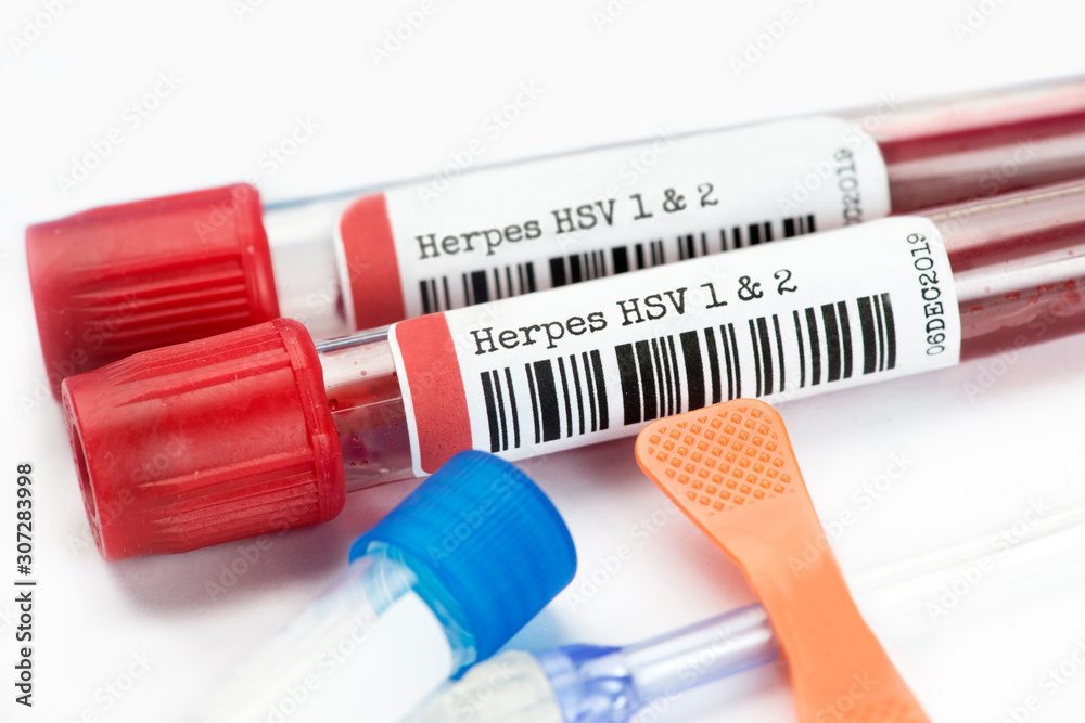 Herpes Blood Test Tubes with catheter. A Herpes blood test can identify