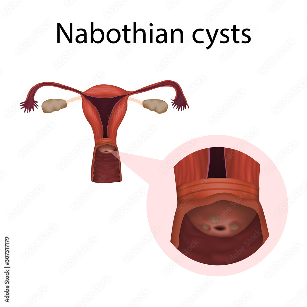 Nabothian cysts. Cervical disease. Medical anatomy illustration. Stock ...