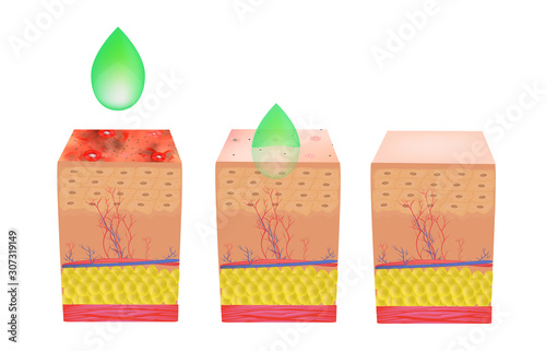 peeling for acne. Inflamed skin acne. Acne purulent. The anatomical structure of the skin. Infographics. Vector illustration on isolated background.