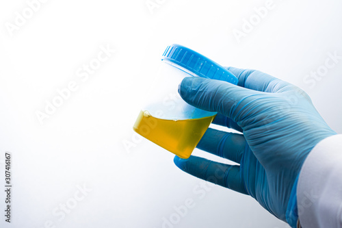 Urine analysis in the laboratory. Medical urine test. Urine sample for laboratory analysis. photo
