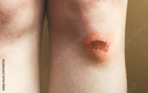 Abrasion on the woman's knee. Injured leg with a red wound. Medical treatment for first aid.