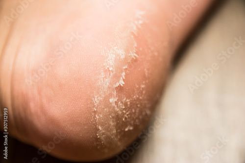heel disease close up
